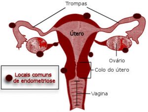 Endometriose Profunda