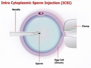 ICSI - Injeção Intracitoplasmática de espermatozóides