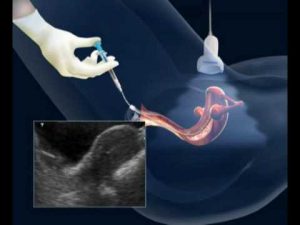 Transferência Embrionária – Etapa ChaveTransferência Embrionária – Etapa Chave
