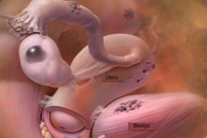 Artigos 24 endometriose 3
