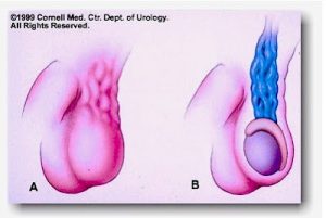 Artigos 17 varicocele foto